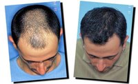 How Does a Hair Transplant Work?