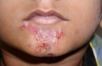 How Does Impetigo Spread?