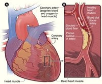 How Long Do Heart Attack Symptoms Last?