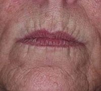 Smoker's wrinkles