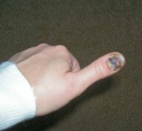 Medical Advice for a Smashed Thumb