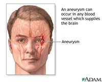 Burst Blood Vessel in Brain
