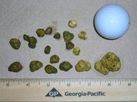What Causes Gallstones?