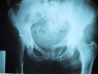Diagnosing pelvis pain