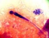 How Does Candida Cause Cancer?
