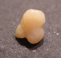 A typical tonsil stone or tonsillolith