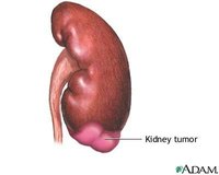 Types of Kidney Tumors
