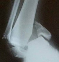 How Does a Dislocated Ankle Heal?