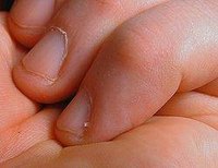 How Does a Hangnail Occur?