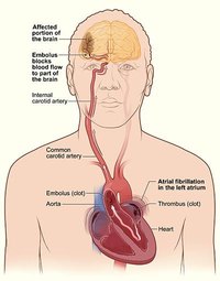 How Does a Stroke Happen?