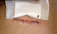 How Does Hernia Surgery Work?
