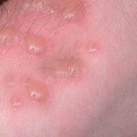 Common Skin Rashes