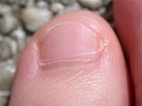 Nail Disorders