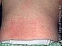 heat rash