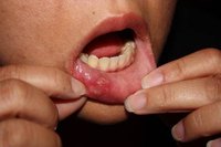 Fever blisters in the mouth