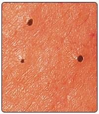 Removing Blackheads With Wax