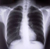 Lung Cancer Stage Four