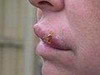 Cold Sore Remedies That Work