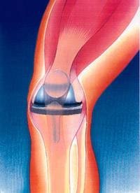 Knee replacement