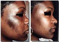 African-American Skin Disorders