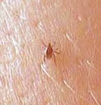 Long Term Effects of Lyme Disease