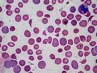 Diseases That Affect the Immune System