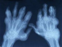 Arthritis Symptoms in the Fingers