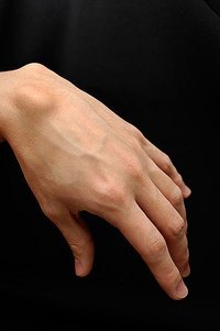 Know if Hand or Wrist Pain is a Ganglion Cyst