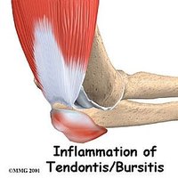 Inflammation of Bursa