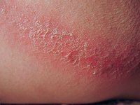 chafing
