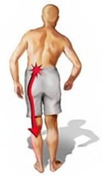 Sciatica