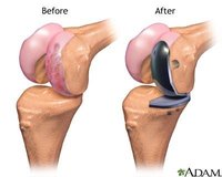 Partial Knee Replacement Surgery