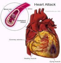 Heart Blockage Symptoms