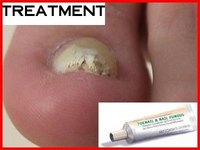 Toenail Fungus Causes