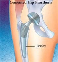Hip Replacement Infection Symptoms