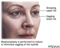 Does Lack of Sleep Lead to Baggy Eyes?
