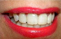 Cost of Dentures Vs. Implants