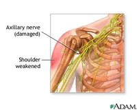 Shoulder Nerve Damage Symptoms
