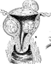Fibroid Cysts in the Uterine Walls