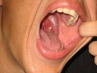 Clean Cryptic Tonsils