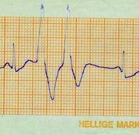 Angina Symptoms in Women