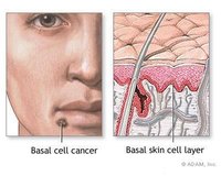 Identify Types of Skin Cancer