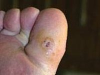Healing skin ulcer