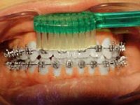 Proper brushing of gums