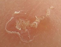 Scabies Burrow
