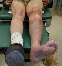 Signs & Symptoms of Blood Clots