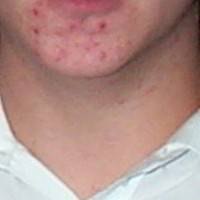 Acne cysts