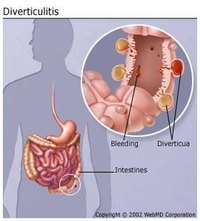 Diverticulitis Diagram