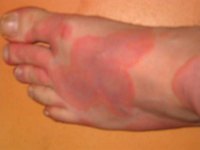 Signs & Symptoms of Allergies