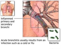 Symptoms of Bronchitis in Toddlers